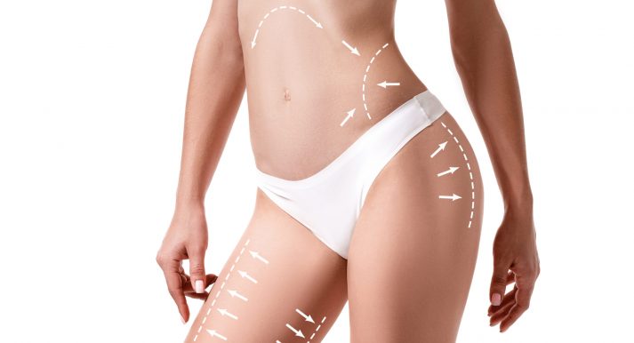 Female body with the drawing arrows on it isolated on white. Fat lose, liposuction and cellulite removal concept. Plastic surgery