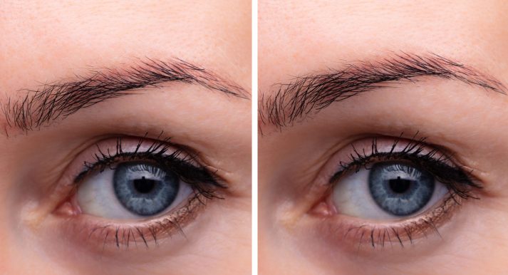 Before And After Endoscopic Eyebrow Lifting Procedure